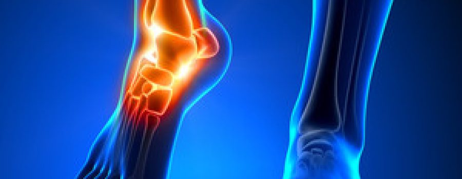 Ankle Sprains and Treatment