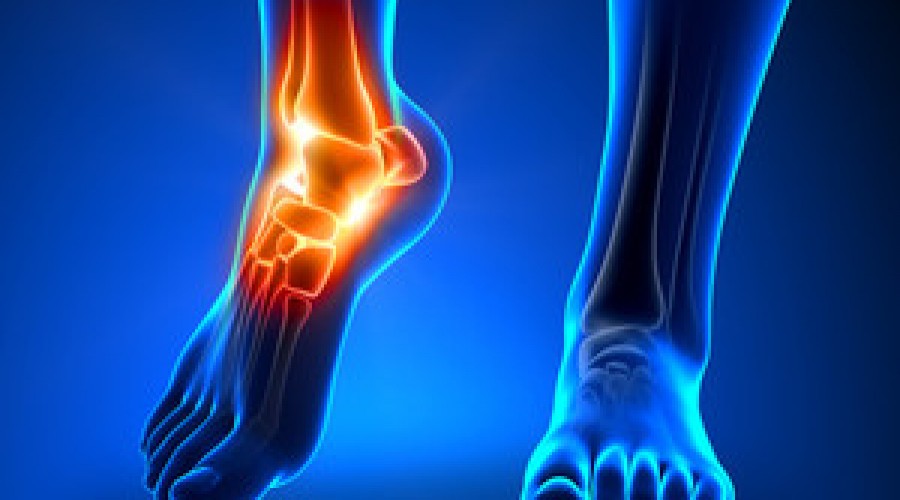 Ankle Sprains and Treatment
