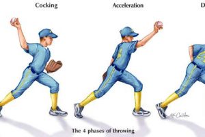 What is Little League Elbow?