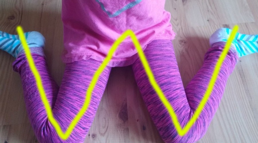 Kids Corner: The Negatives of W-Sitting